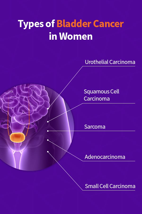 02 Types Of Bladder Cancer in Women