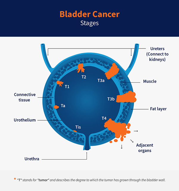 Bladder Cancer Stages | Cxbladder