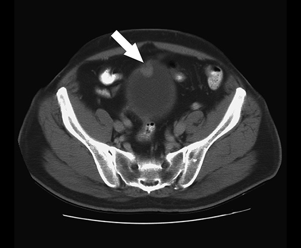 Detecting Bladder Cancer With A Ct Scan Ultrasound Or Mri Cxbladder