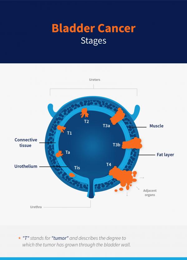 bladder cancer stages