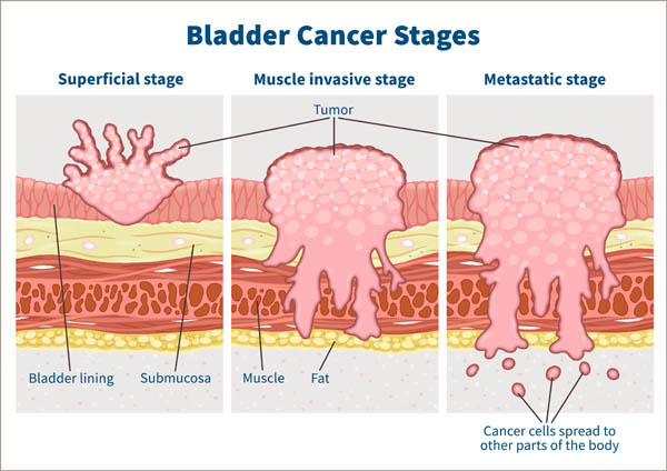 prostate and bladder cancer survival rate)